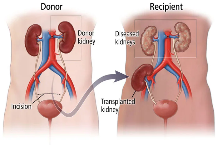 Kidney Transplantation Donor Types